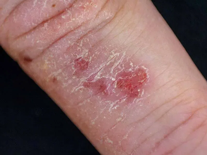 Psoriasis