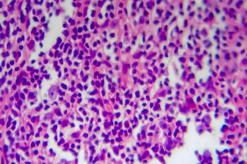 hodgkin-lymphoma