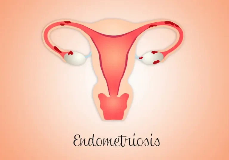 Signs-You-Might-Have-Endometriosis-Are-You-Affected