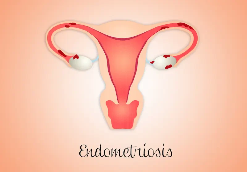 Signs-You-Might-Have-Endometriosis-Are-You-Affected