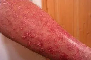 Psoriasis-These-Tips-Can-Help-Fix-It!