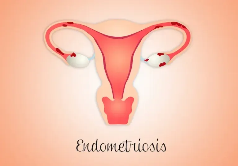 Signs-You-Might-Have-Endometriosis-Are-You-Affected