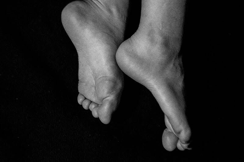 Bunions