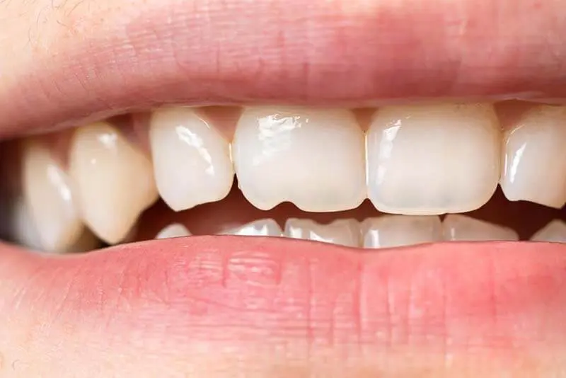 teeth-grinding