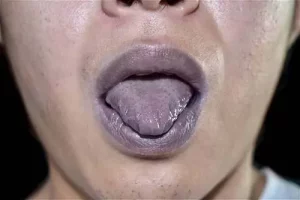 Covid-Tongue-Syndrome-Is-It-Real-or-Fake