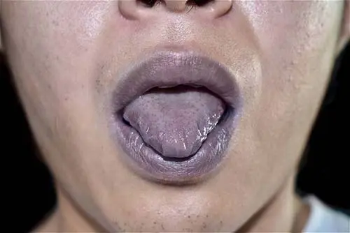Covid-Tongue-Syndrome-Is-It-Real-or-Fake