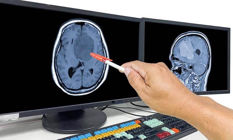 Glioblastoma-The-Most-Aggressive-Brain-Cancer-You-Need-to-Know-About