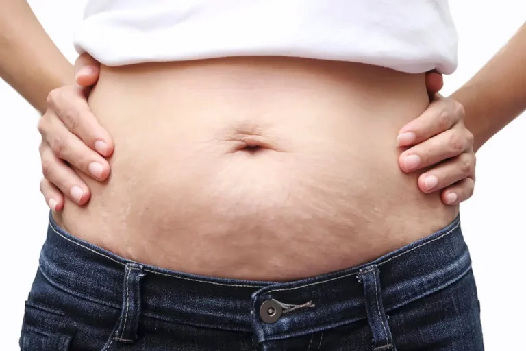 Stretch-Mark-Solutions-How-to-Restore-Your-Skin-After-Pregnancy