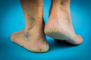 Nuts-for-Smooth-Feet-Natural-Remedies-for-Rough-Skin