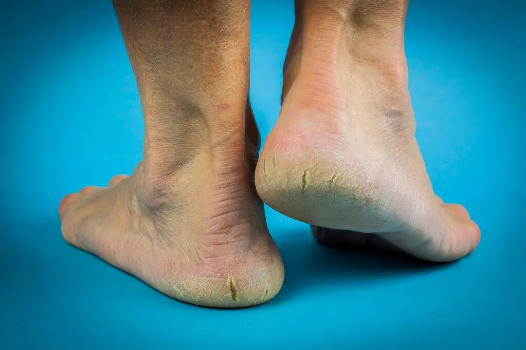 Nuts-for-Smooth-Feet-Natural-Remedies-for-Rough-Skin