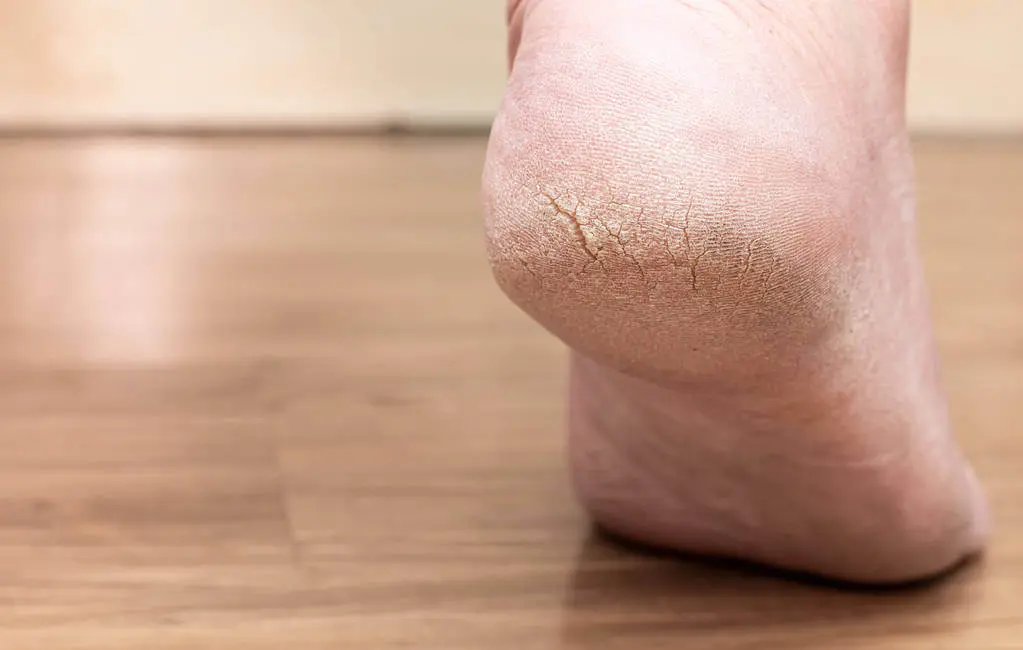 cracked heels